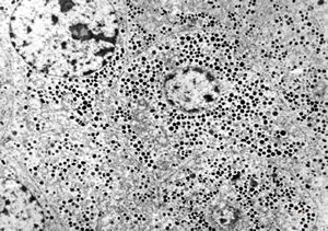 F, 71y. | carcinoid … metastasis to lymphonode